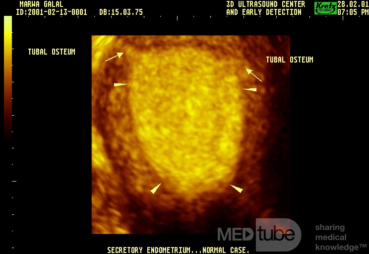 Sekretorisches Endometrium