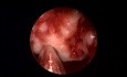 Resektion eines teratomähnlichen Nasaltumors – Nasennebenhöhlenchirurgie