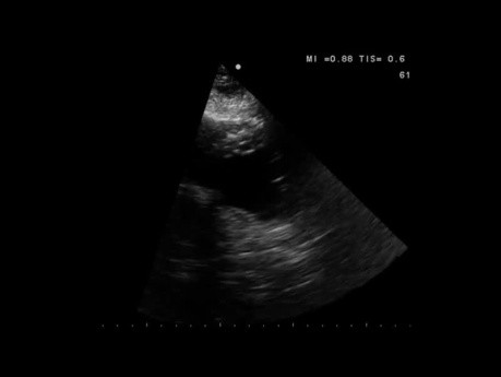 Echokardiographie-Quiz. Jede Abnormalität der systolischen Funktion des linken Ventrikels