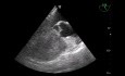 Ein seltener Fall (Quiz) der transösophagealen Echokardiographie (Tee Ortoe) und Überprüfung einiger grundlegender Ansichten