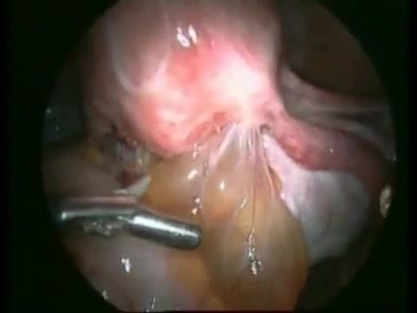Exzision eines rektovaginalen endometriotischen Knotens durch laparoskopische Technik