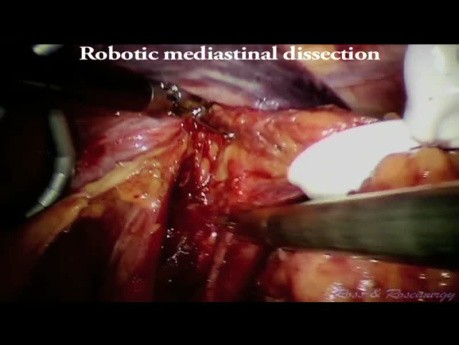 Roboterunterstützte laparoskopische transhiatale Ösophagektomie.