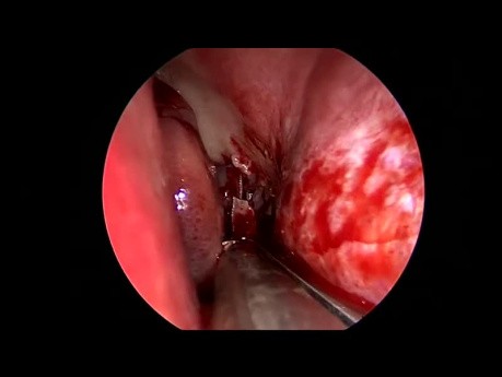 Antrochoanalpolyp - Nasennebenhöhlenchirurgie