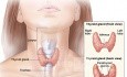 Operationstechnik der totalen Thyreoidektomie (11 Schritte zur Vermeidung von Komplikationen)