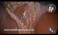 Akute Cholezystitis erleichtert die laparoskopische Cholezystektomie