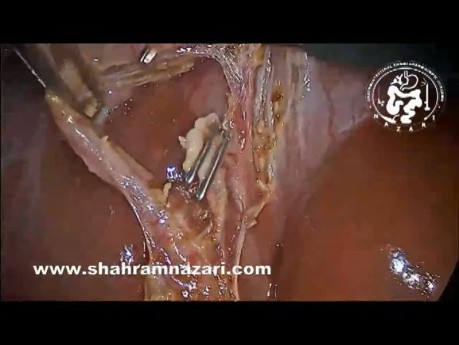 Akute Cholezystitis erleichtert die laparoskopische Cholezystektomie