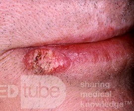 Plattenepithelkarzinom der Lippe
