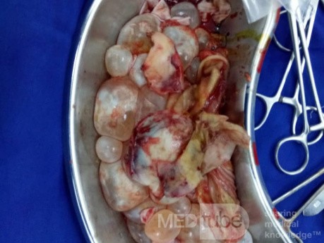 Intraoperative Darstellung der Tochterzysten bei einer Echinokokkose