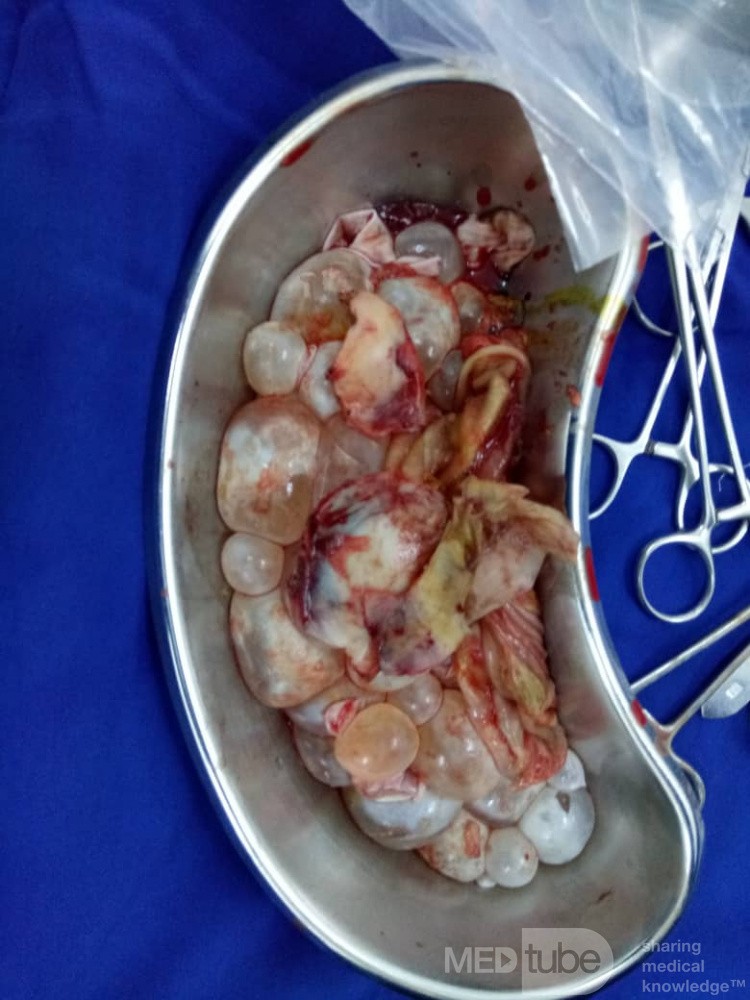 Intraoperative Darstellung der Tochterzysten bei einer Echinokokkose