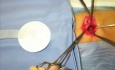 Die Operation der Nabelhernie