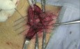 Große Leistenhernie - Operation mit einem Netz- und Gewebekleber