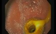 Cholezystogastrostomie