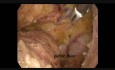 Laparoskopische tiefe anteriore Resektion für Rektumkarzinom
