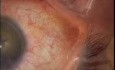  Phakoemulsifikation - Weißer Katarakt