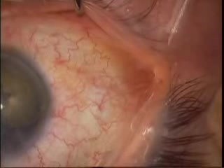 Phakoemulsifikation - Weißer Katarakt