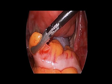 Akutes Abdomen - Torsion des Teratoms
