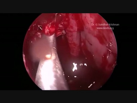 Endo-Maxillektomie