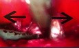 vNOTES-Verfahren des vorderen vesiko-uterinen Peritoneums