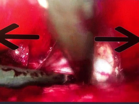vNOTES-Verfahren des vorderen vesiko-uterinen Peritoneums