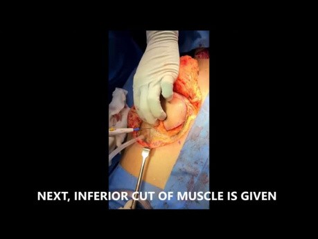 Haut-Muskellappen vom Musculus pectoralis major