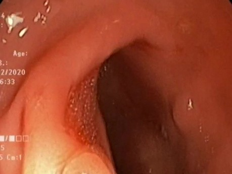 Kaltschlinge - Sitzender Polyp