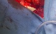 Lungenloser Patient unter VA-ECMO in Überbrückung bis zur Transplantation