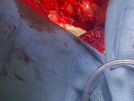 Lungenloser Patient unter VA-ECMO in Überbrückung bis zur Transplantation