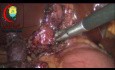 Klinischer Fall: Ein kurzer Ductus cysticus und ein Stein der in den Gallenblasenhals eingedrungen ist