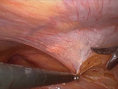 Laparoskopische Hernien-OP in TAPP-Technik - ProGrip-Netz