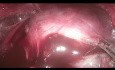 TOETVA - Transorale endoskopische Thyreoidektomie, vestibulärer Zugang