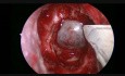 Endoskopische endonasale Chirurgie