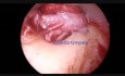 Endoskopische Stapedektomie
