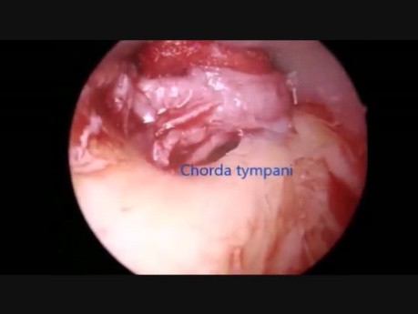 Endoskopische Stapedektomie