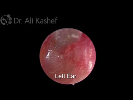 Anlage von Drainagen im Zuge einer chronischen mukösen Otitis media