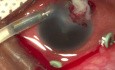 Chirurgische Behandlung von Endophthalmitis