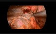 Laparoskopische Reparatur einer linksseitigen Zwerchfellhernie bei einem 12-jährigen Jungen