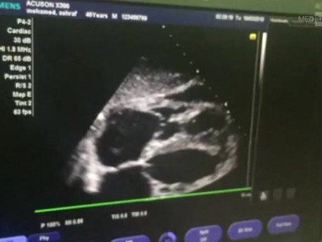 Echokardiographische Darstellung eines mäßigen Perikardergusses