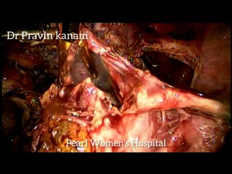 Laparoskopie einer rupturierten Eileiterschwangerschaft mit Schokoladenzyste und Myomektomie