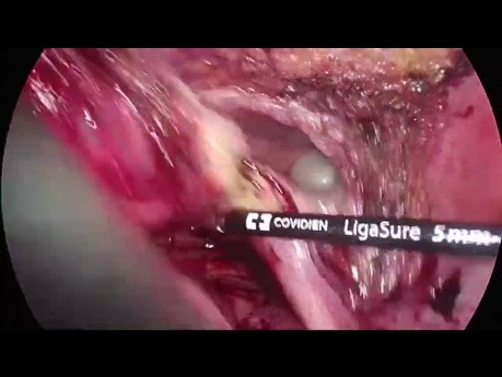 Laparoskopische multiviszerale Resektion bei fortgeschrittenem Sigmakarzinom (cT4)