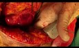 Perforation der linken Vorhofohrmuschel während des ASD-Verschlusses verursachte eine Tamponade und führte zu einem Herzstillstand