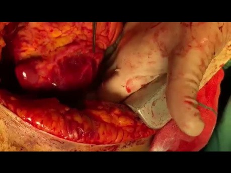 Perforation der linken Vorhofohrmuschel während des ASD-Verschlusses verursachte eine Tamponade und führte zu einem Herzstillstand