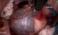 Ovarialzystektomie – eine narbenlose Operation