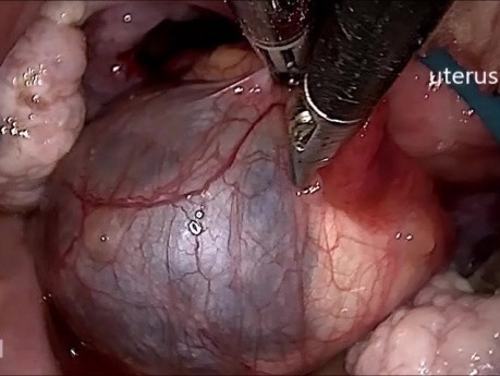 Ovarialzystektomie – eine narbenlose Operation