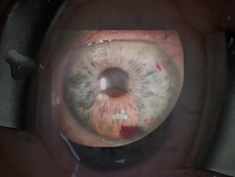 Gezielte Injektion kleiner Implantate, Implantattechnik und -strategien