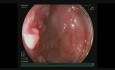 Riesiger absteigender Polyp