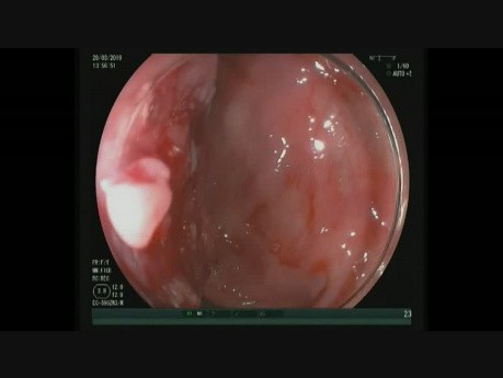 Riesiger absteigender Polyp