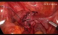 Laparoskopische Myomektomie, Ovarialzystektomie, Cholezystektomie