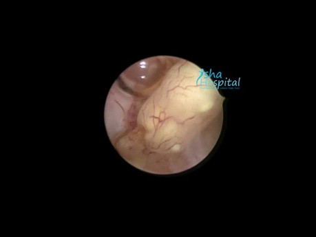 Hysteroskopische Polypektomie bei postmenopausalen Blutungen
