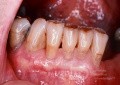 Freiliegende Zahnwurzeln