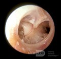 Subtotale Trommelfellperforation - die Öffnung der Tuba auditiva 